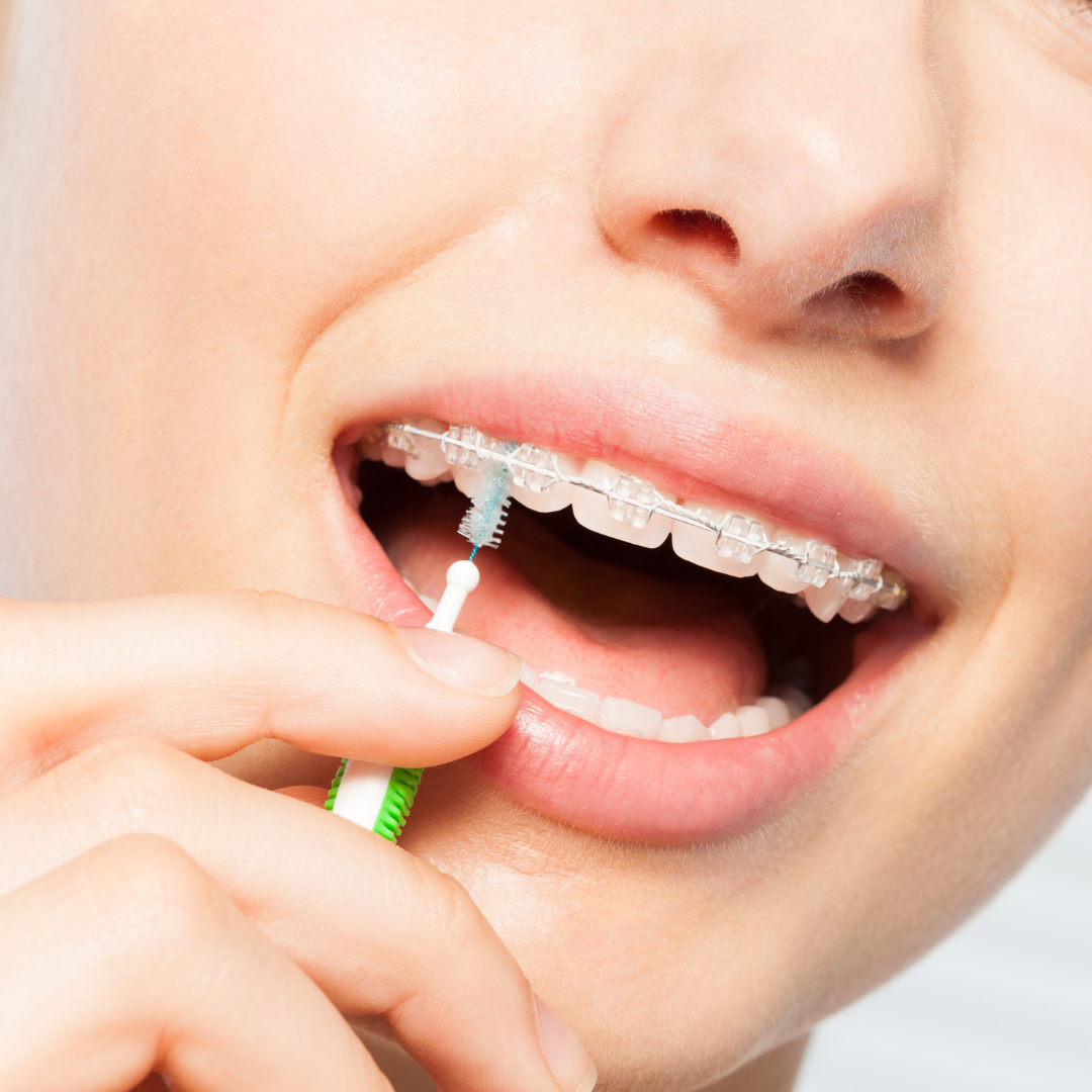 Caring for your braces during treatment