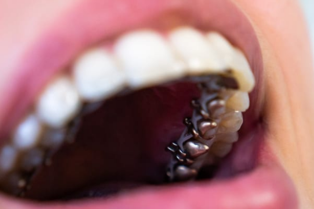 Invisalign clear aligners