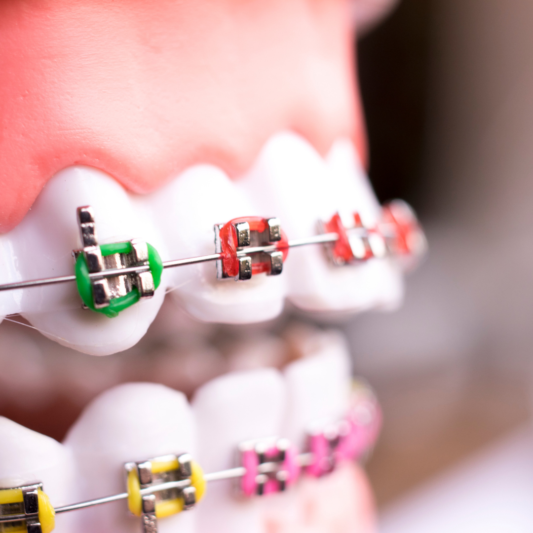 Traditional metal braces