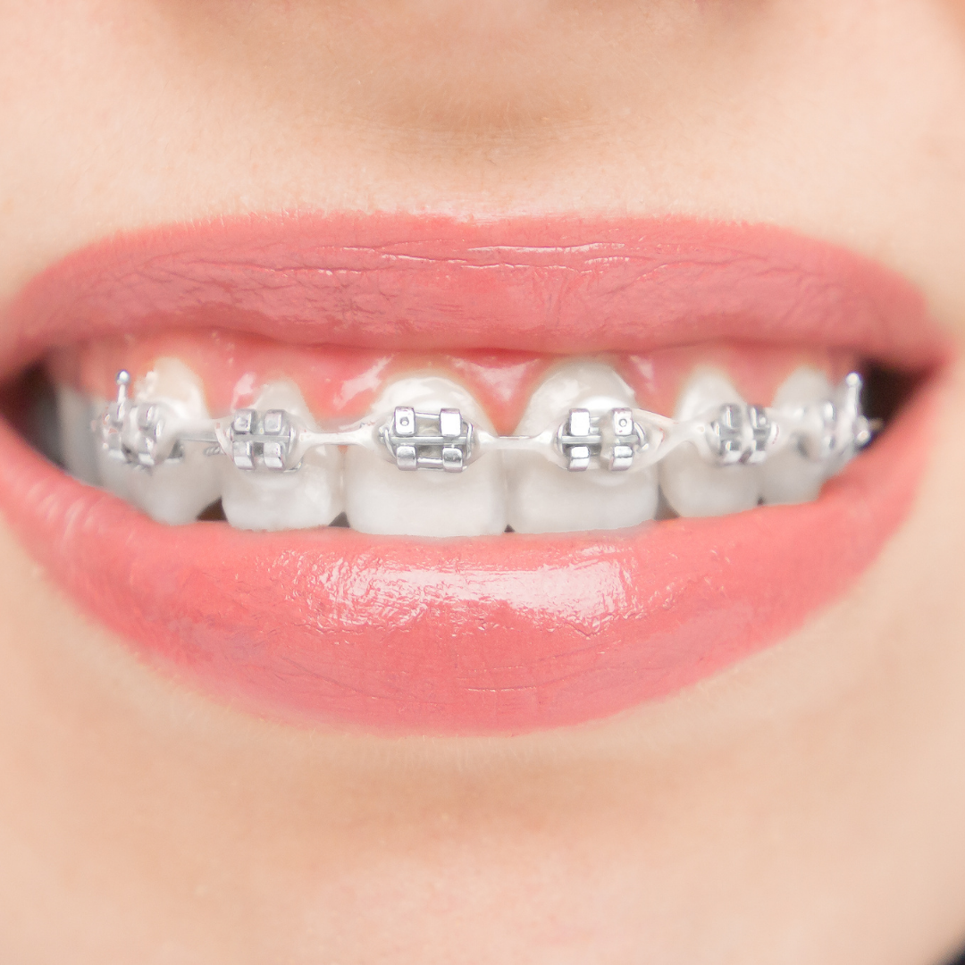 Lingual braces — start of treatment