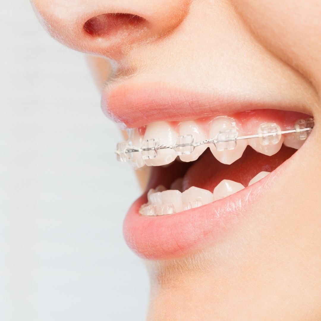 Ceramic clear braces