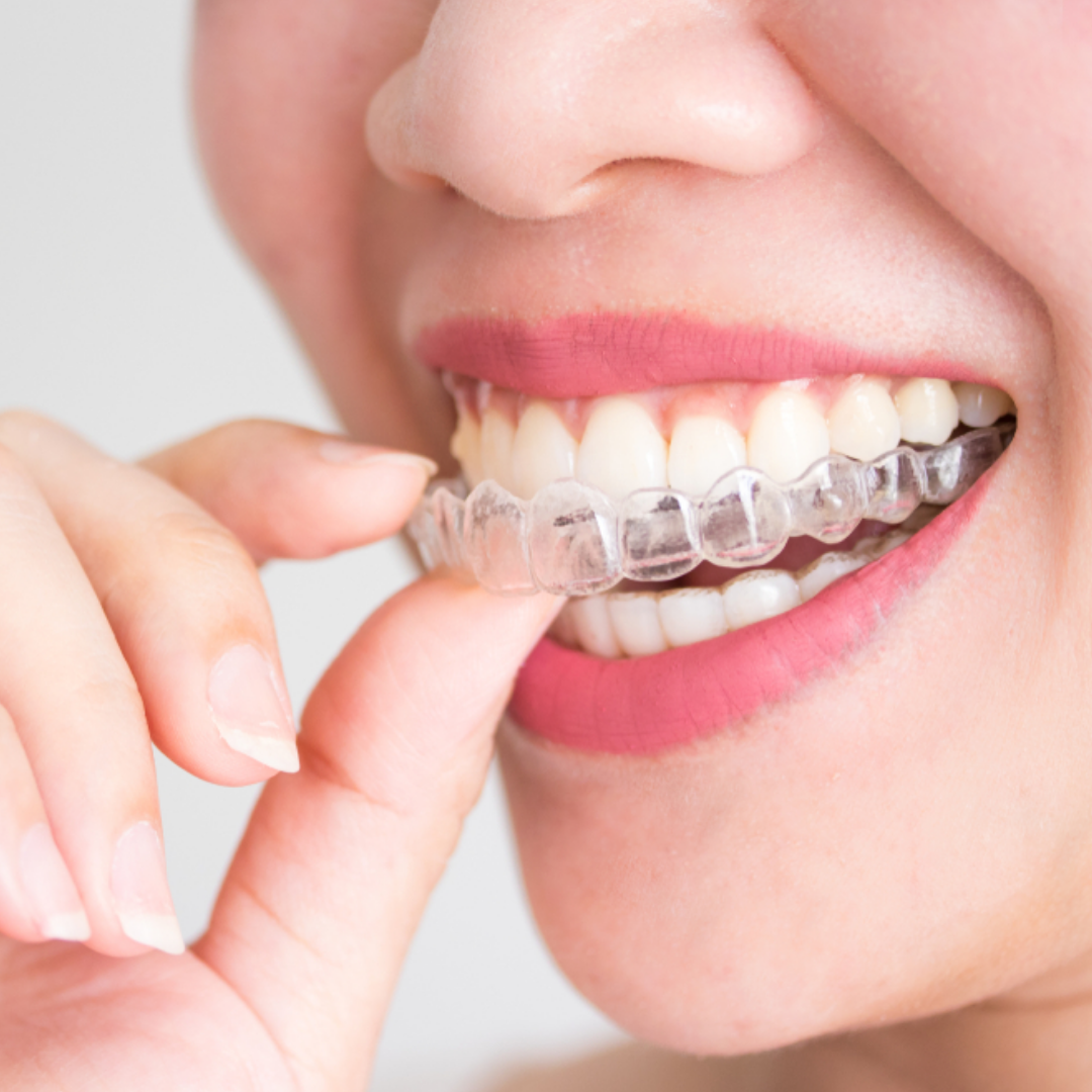 Invisalign clear aligners