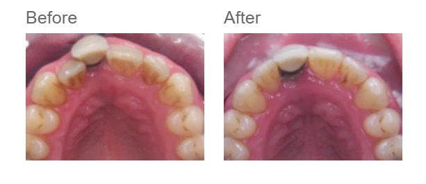 Patient case 1 — before and after Invisalign