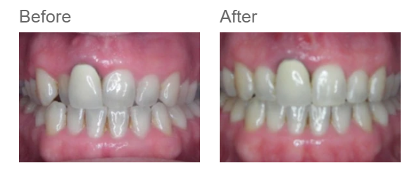 Patient case 2 — before and after metal braces