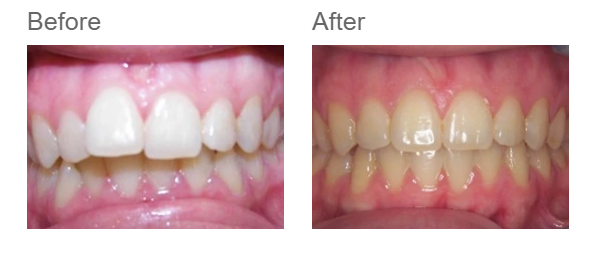 Patient case 3 — before and after ceramic braces